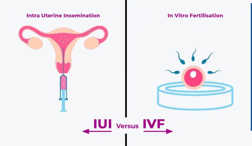 You are currently viewing What Is IUI vs. IVF? Your Ultimate Guide to Fertility Treatments