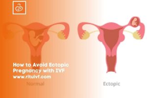 Read more about the article How to Avoid Ectopic Pregnancy with IVF: Your Ultimate Guide to a Safer Journey