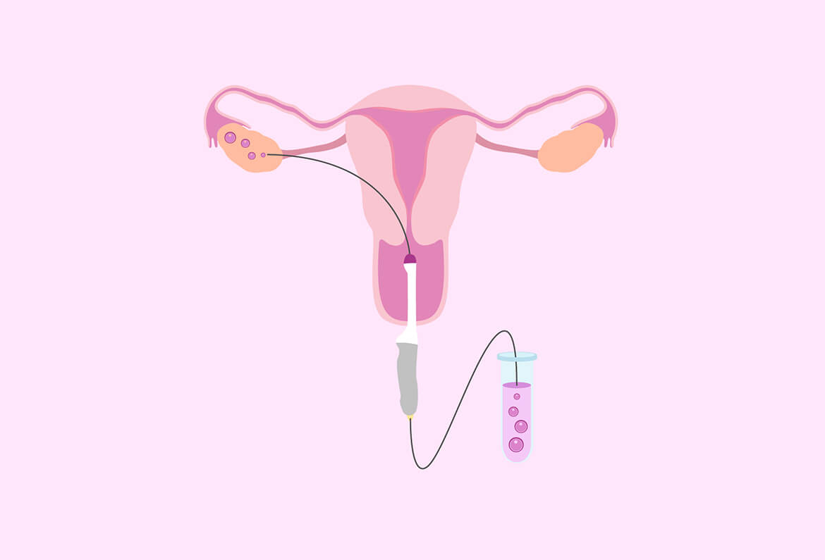 Read more about the article How Many Eggs Are Collected in IVF? Your Ultimate Guide to Understanding the Process