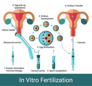 Read more about the article What’s IVF Mean? Your Ultimate Guide to In Vitro Fertilization