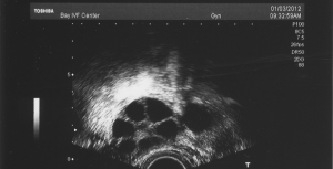 Read more about the article How Many Follicles Are Good for IVF? Your Ultimate Guide to Success