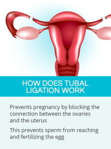 Read more about the article Can You Do IVF After Tubal Ligation? The Ultimate Guide to Your Options